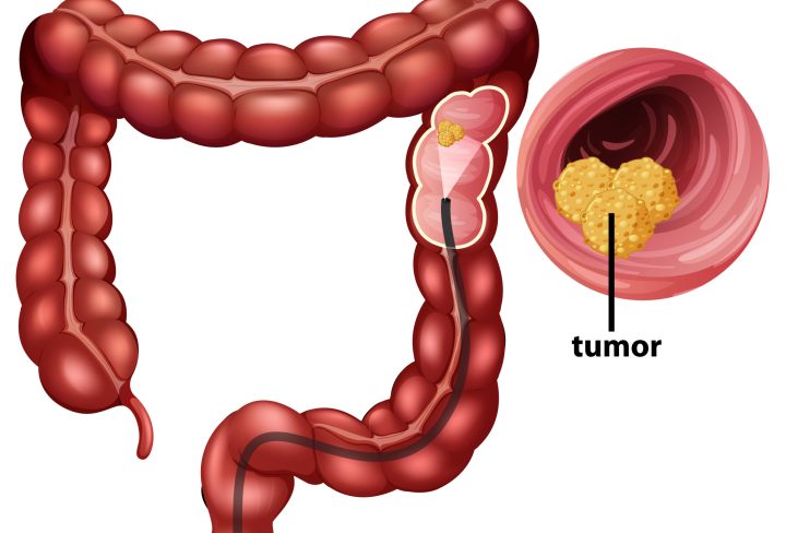 Colorectal Cancer (CRC) infographic for education illustration